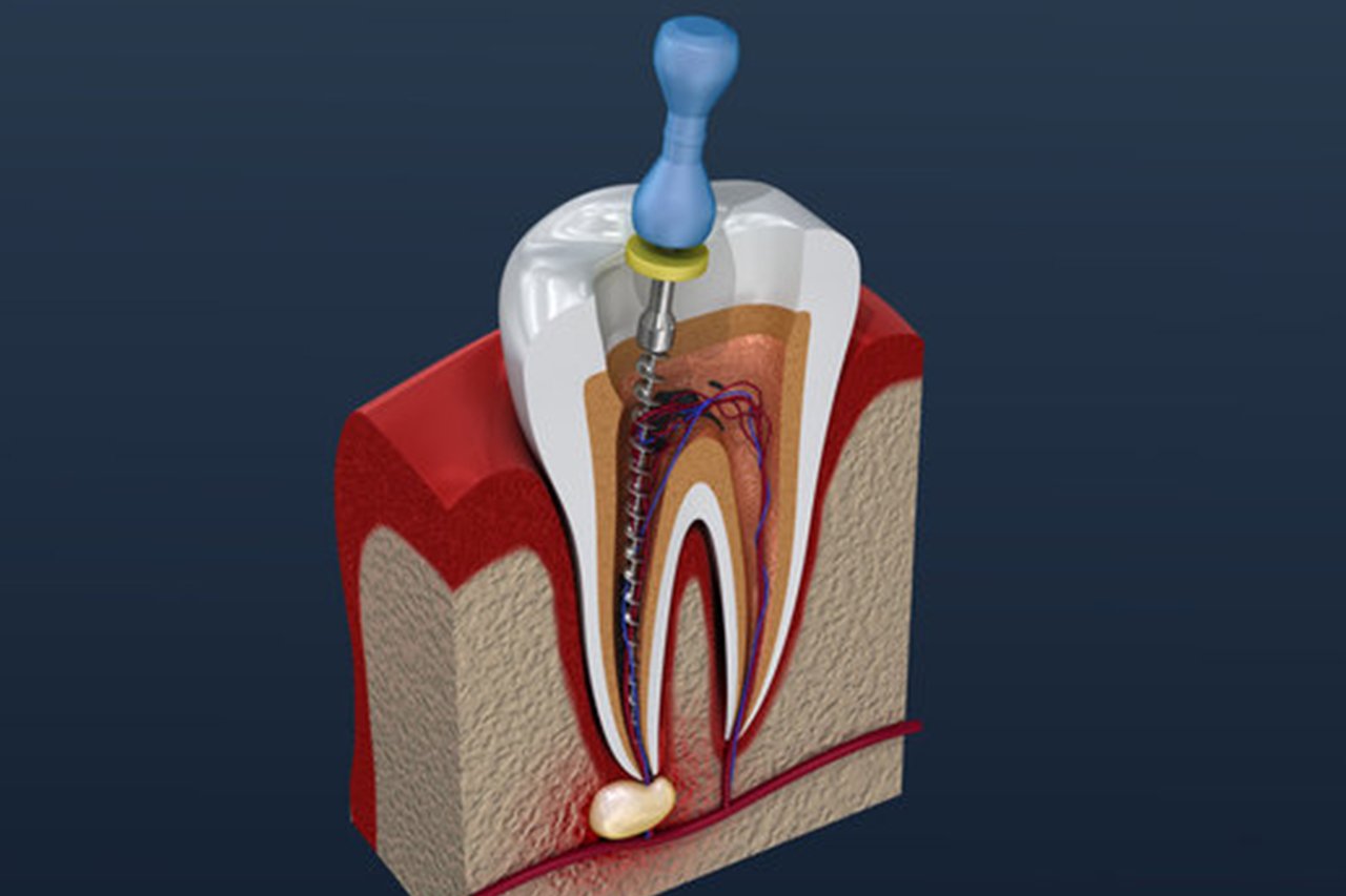 root-canal-treatment